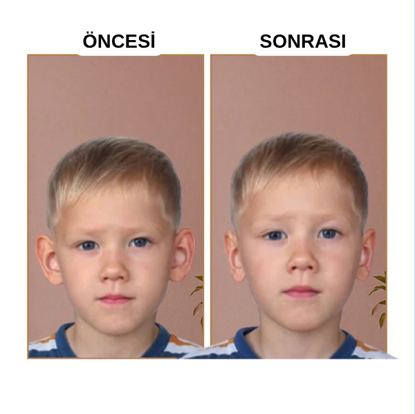 EARLEPS™ Kulak Bandı (20 Adet 3-4 Ay Kullanım İçin Uygun)