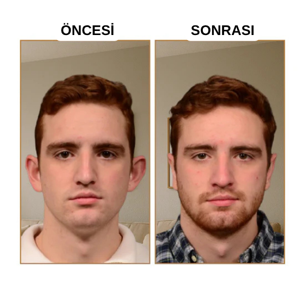 EARLEPS™ Kulak Bandı (20 Adet 3-4 Ay Kullanım İçin Uygun)